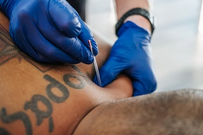 Is Therapeutic Dry Needling Right for me?